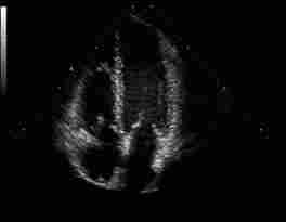 Echokardiographie: Herz im 4 - Kammerblick